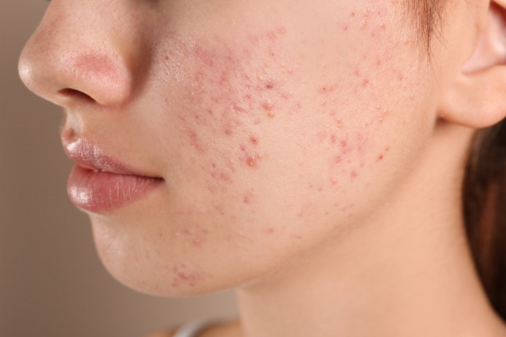 1. oily and acne
