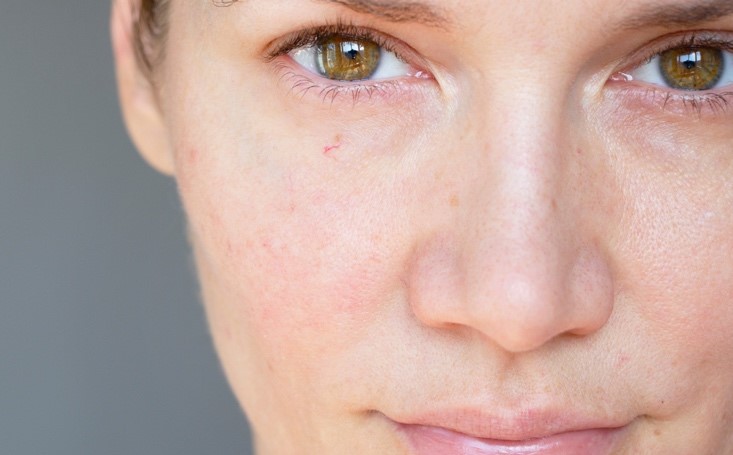 2. dry and sensitive skin
