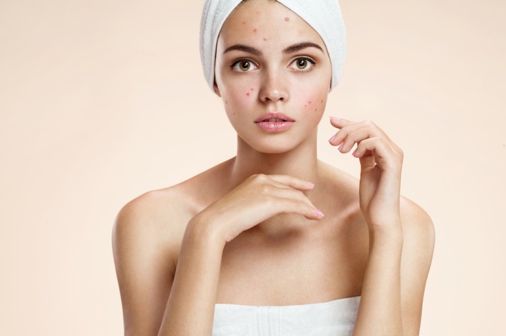 Follow These 5 Steps to Treat Cystic Acne