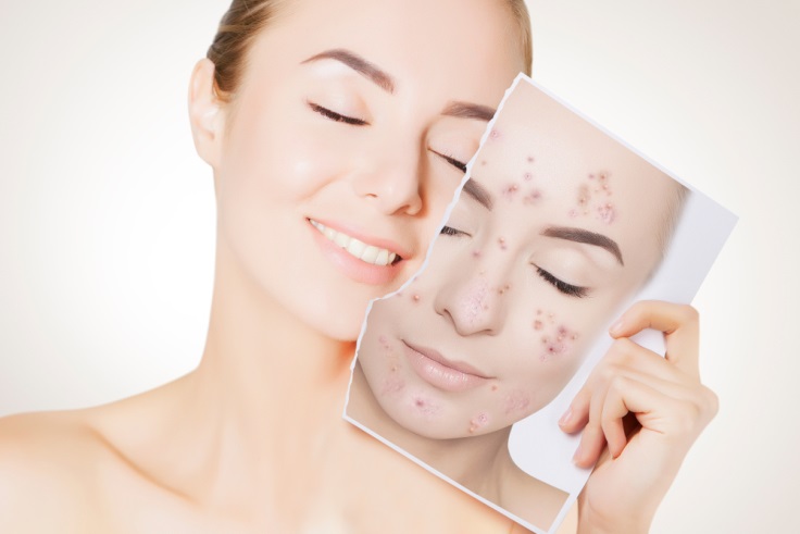 How to Get Rid of Black Spots Acnes