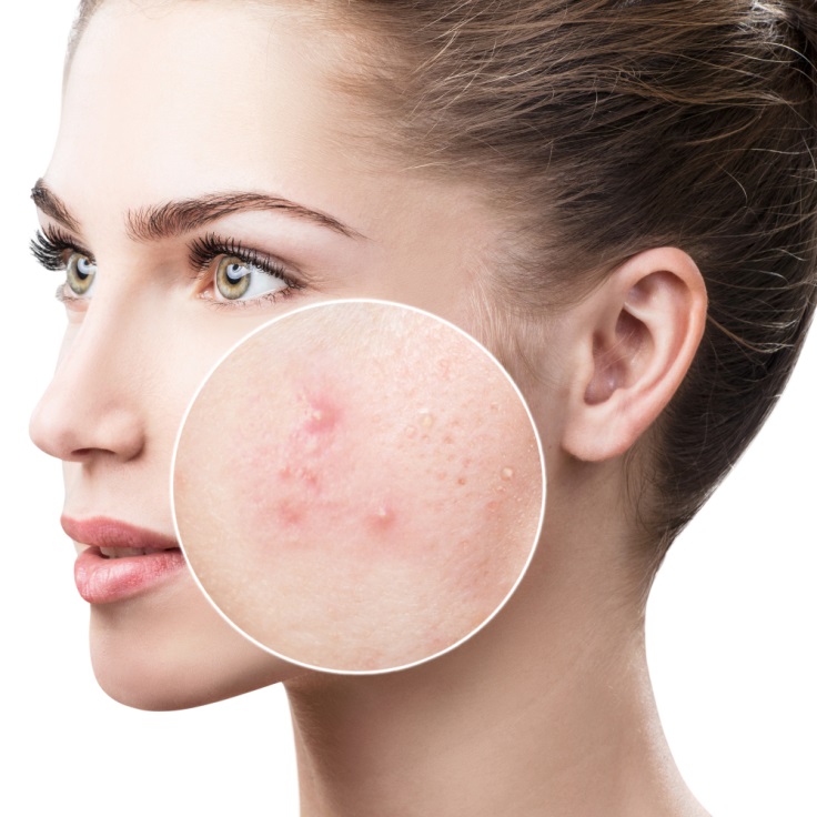 How to Get Rid of Inflamed Acne