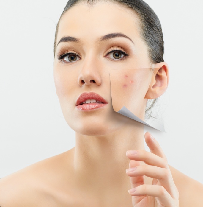 First Aid for Treating Stubborn Acne